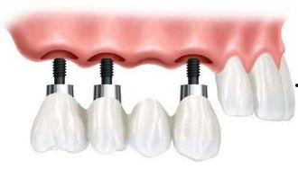 佛山种牙爆料事件最新